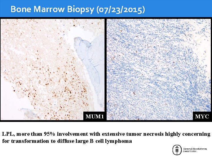 Bone Marrow Biopsy (07/23/2015) MUM 1 MYC LPL, more than 95% involvement with extensive
