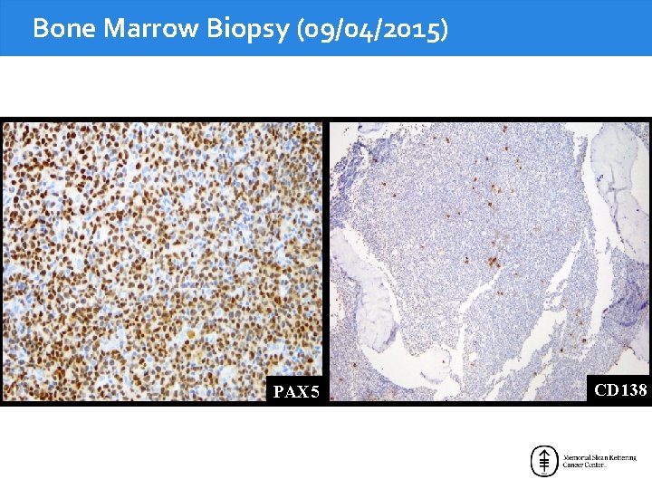 Bone Marrow Biopsy (09/04/2015) PAX 5 CD 138 