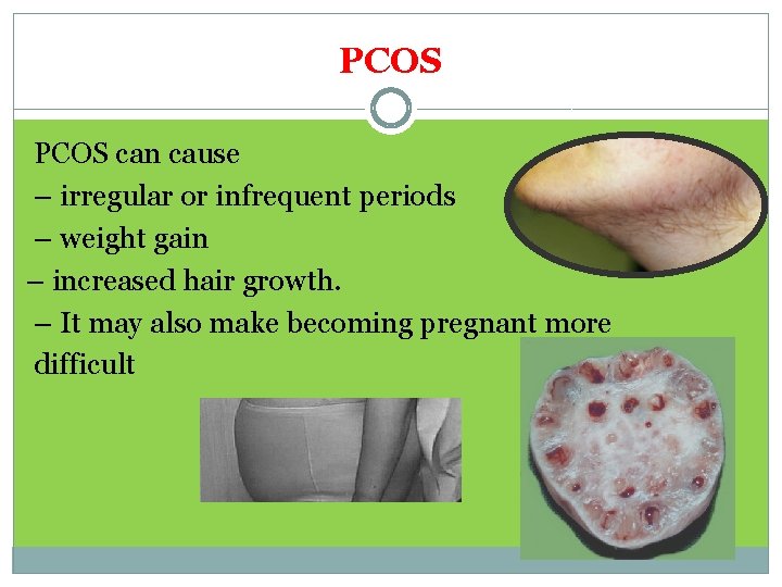 PCOS can cause – irregular or infrequent periods – weight gain – increased hair