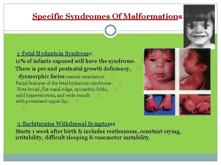 Specific Syndromes Of Malformations 1 -Fetal Hydantoin Syndrome: 11% of infants exposed will have