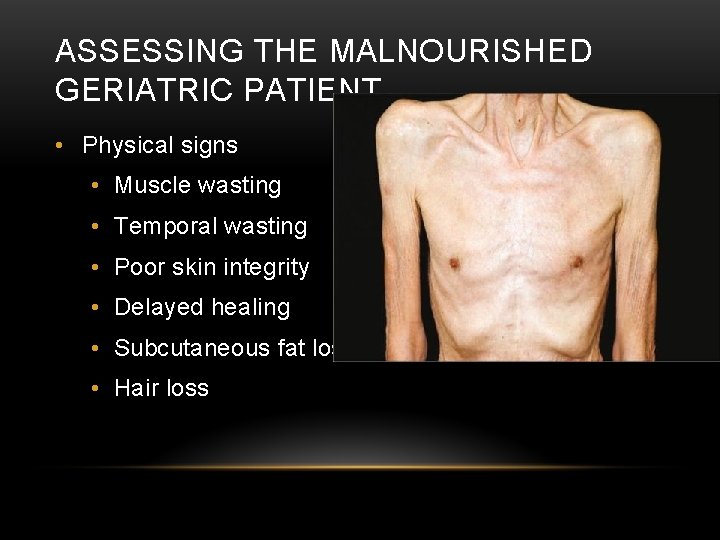 ASSESSING THE MALNOURISHED GERIATRIC PATIENT • Physical signs • Muscle wasting • Temporal wasting ASSESSING THE MALNOURISHED GERIATRIC PATIENT • Physical signs • Muscle wasting • Temporal wasting