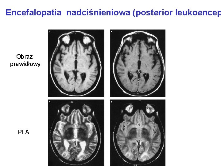 Encefalopatia nadciśnieniowa (posterior leukoencep Obraz prawidłowy PLA 