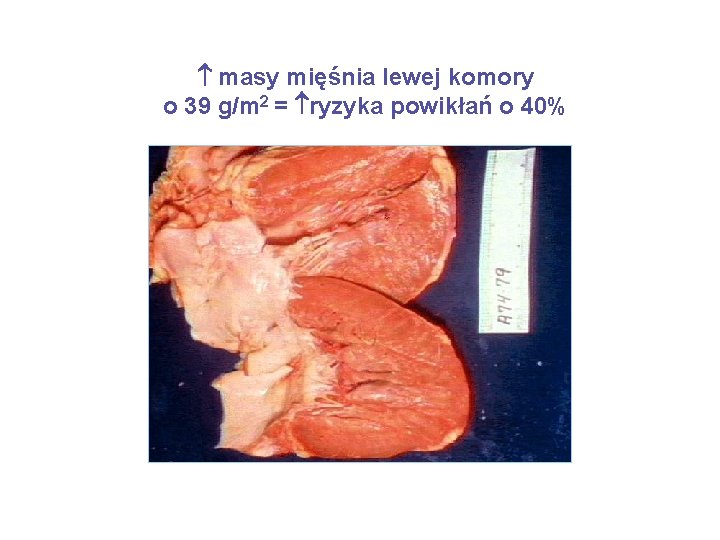  masy mięśnia lewej komory o 39 g/m 2 = ryzyka powikłań o 40%