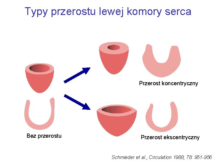 Typy przerostu lewej komory serca Przerost koncentryczny Bez przerostu Przerost ekscentryczny Schmieder et al.