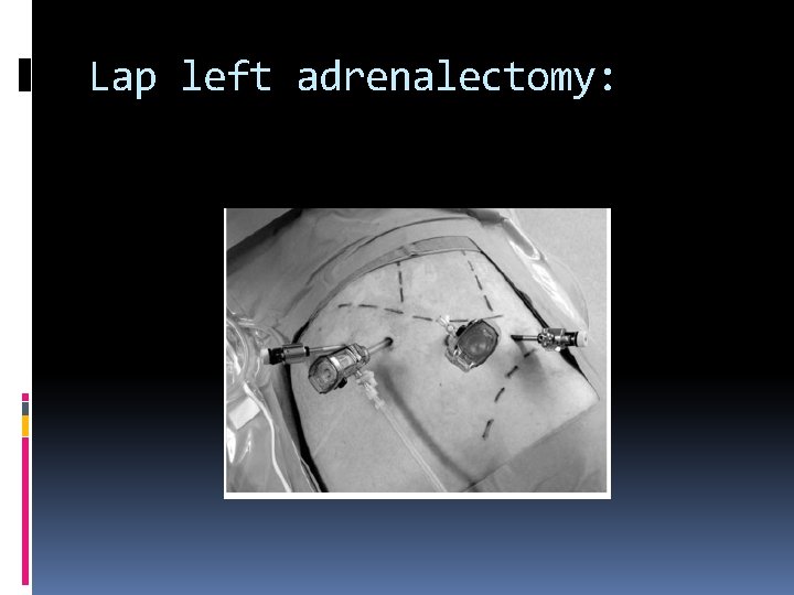 Lap left adrenalectomy: 