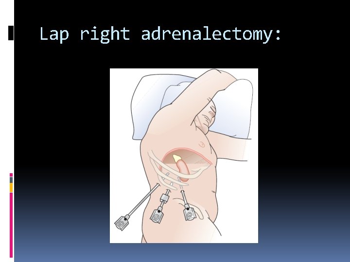 Lap right adrenalectomy: 