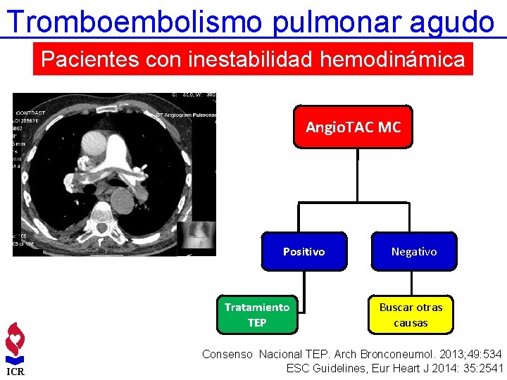 Tromboembolismo pulmonar agudo Pacientes con inestabilidad hemodinámica Angio. TAC MC Positivo Tratamiento TEP ICR