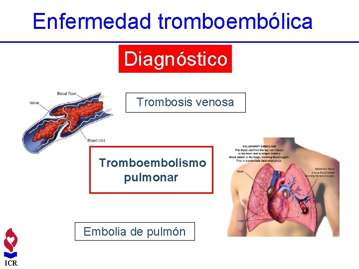 Enfermedad tromboembólica Diagnóstico Trombosis venosa Tromboembolismo pulmonar Embolia de pulmón ICR 