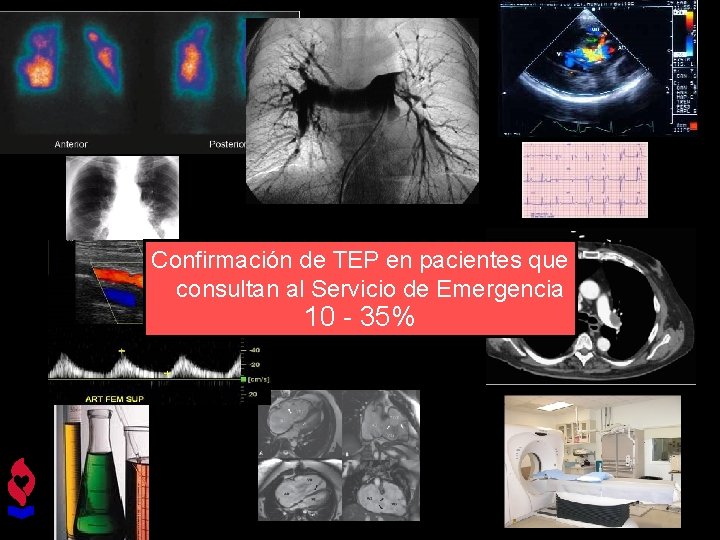 Diagnóstico Confirmación de TEP en pacientes que consultan al Servicio de Emergencia 10 -