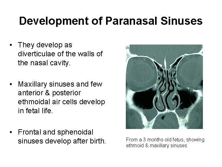 Development of Paranasal Sinuses • They develop as diverticulae of the walls of the