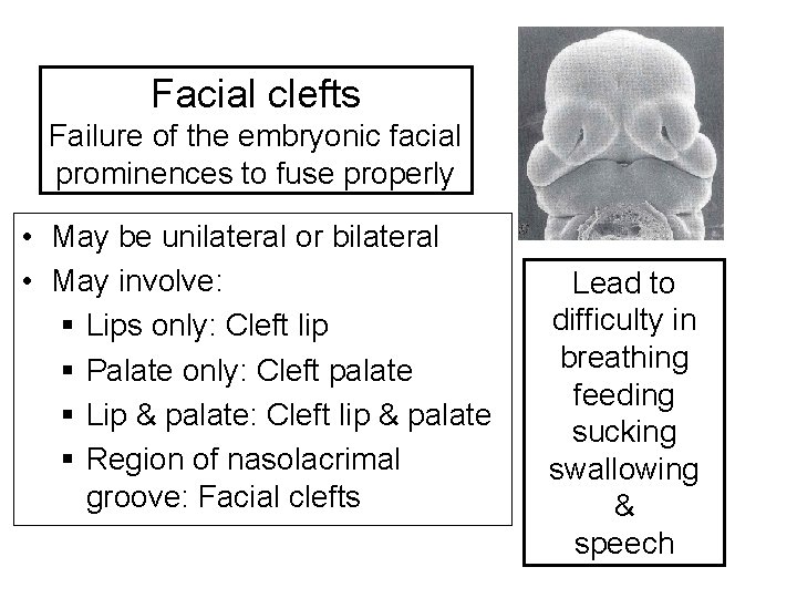 Facial clefts Failure of the embryonic facial prominences to fuse properly • May be