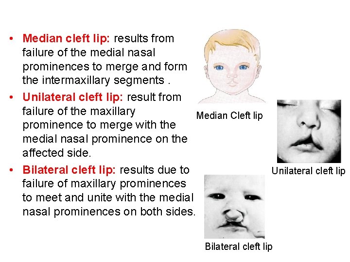  • Median cleft lip: results from failure of the medial nasal prominences to