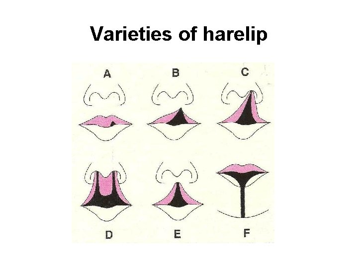 Varieties of harelip 
