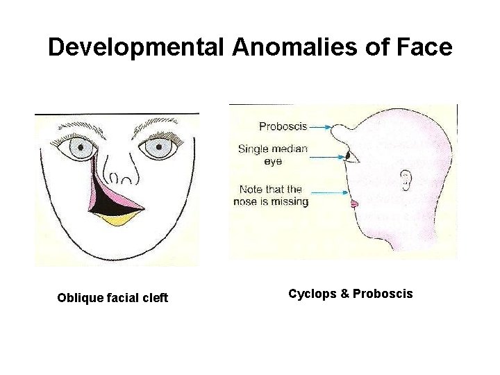 Developmental Anomalies of Face Oblique facial cleft Cyclops & Proboscis 
