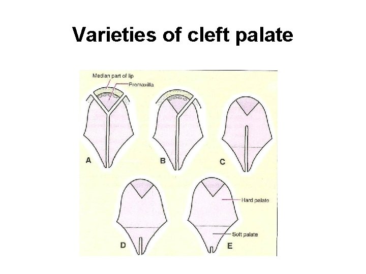 Varieties of cleft palate 