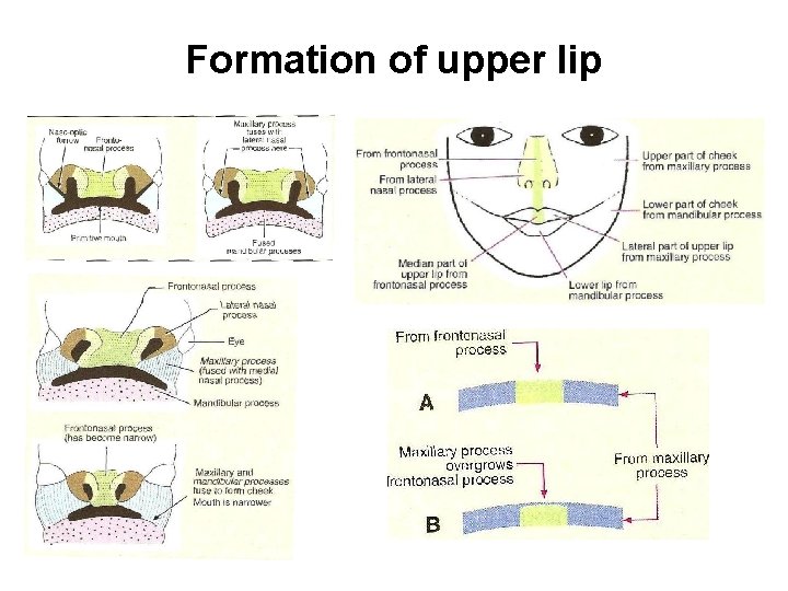 Formation of upper lip 