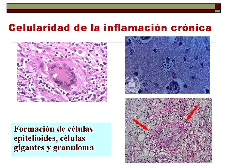 Celularidad de la inflamación crónica Formación de células epitelioides, células gigantes y granuloma 