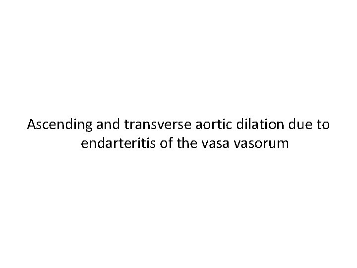 Ascending and transverse aortic dilation due to endarteritis of the vasa vasorum 