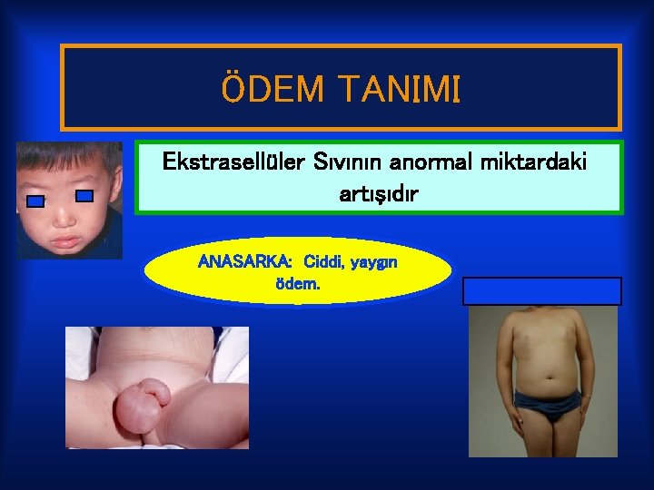 ÖDEM TANIMI Ekstrasellüler Sıvının anormal miktardaki artışıdır ANASARKA: Ciddi, yaygın ödem. 