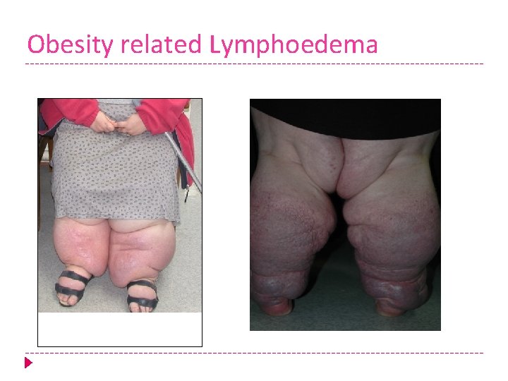 Obesity related Lymphoedema 