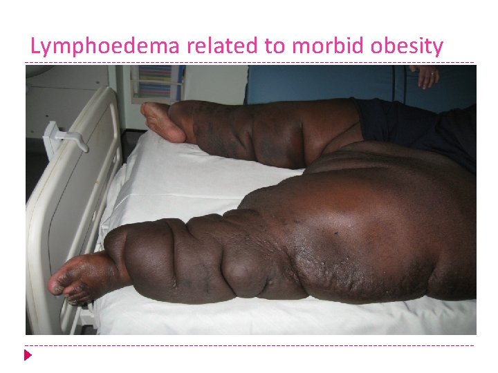 Lymphoedema related to morbid obesity 