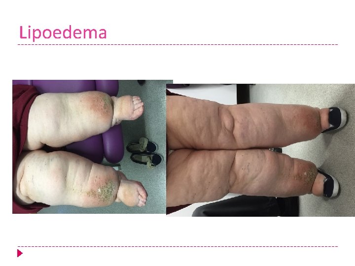 Lipoedema 