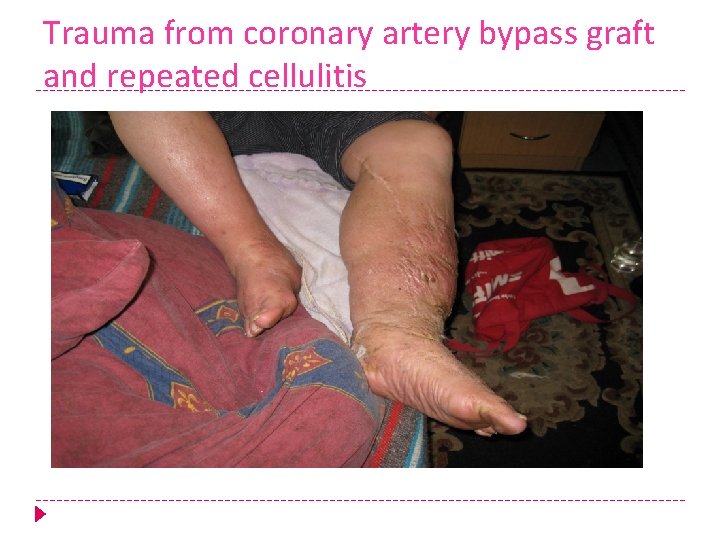 Trauma from coronary artery bypass graft and repeated cellulitis 