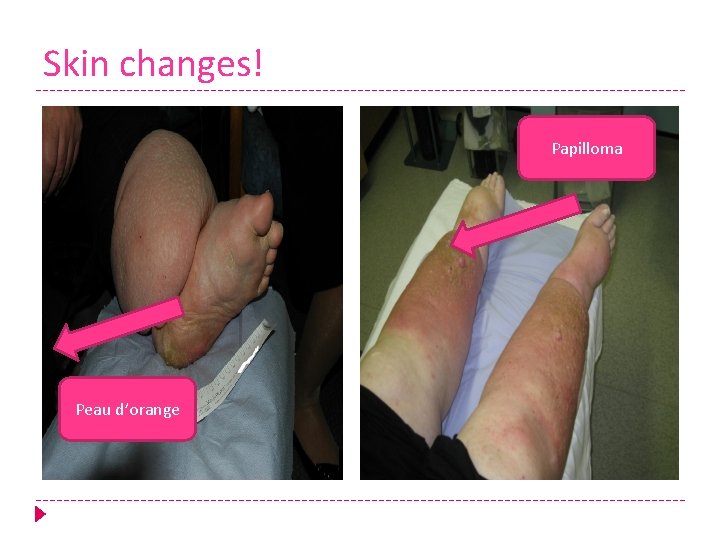 Skin changes! Papilloma Peau d’orange 