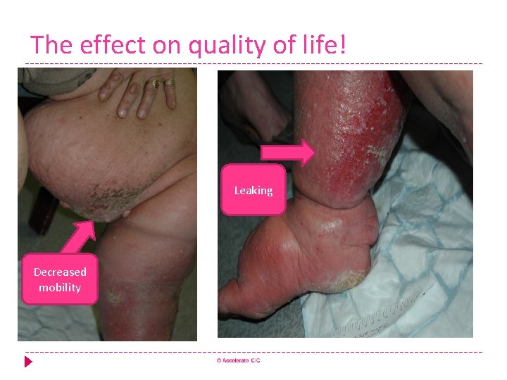 The effect on quality of life! Leaking Decreased mobility 