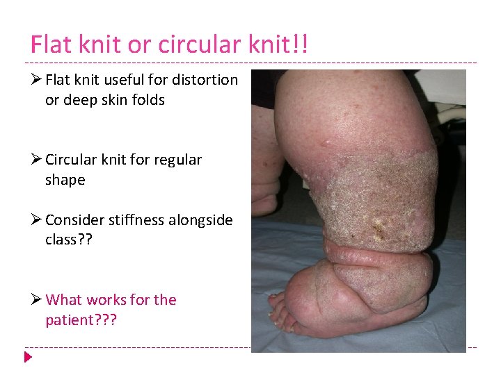 Flat knit or circular knit!! Ø Flat knit useful for distortion or deep skin