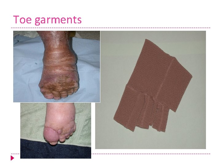 Toe garments 