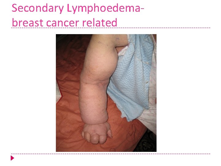 Secondary Lymphoedemabreast cancer related 