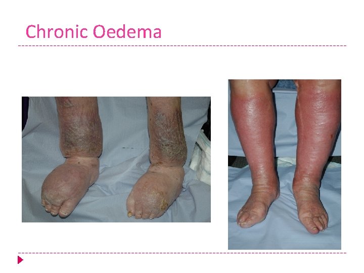 Chronic Oedema 