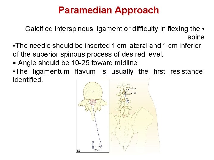 Paramedian Approach Calcified interspinous ligament or difficulty in flexing the • spine • The