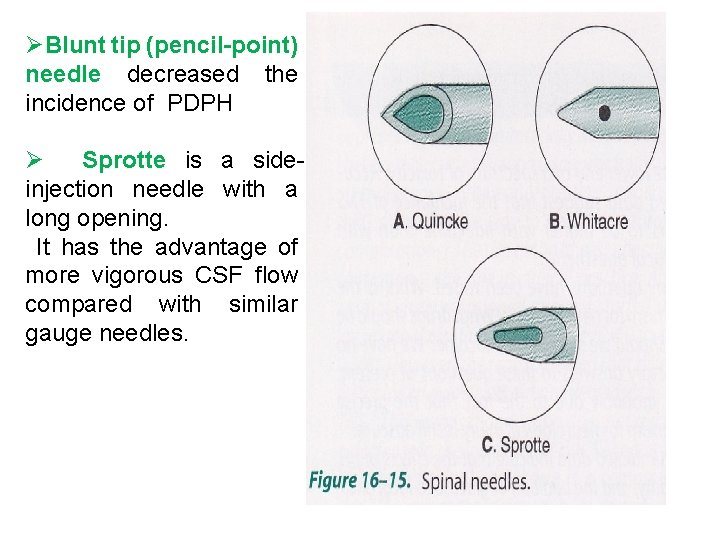 ØBlunt tip (pencil-point) needle decreased the incidence of PDPH Ø Sprotte is a sideinjection