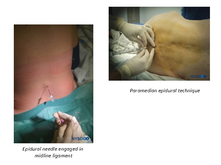 Paramedian epidural technique Epidural needle engaged in midline ligament 