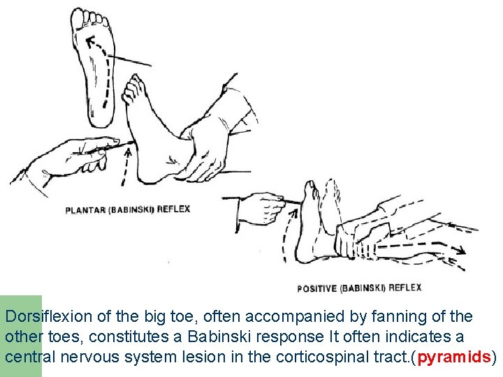 Dorsiflexion of the big toe, often accompanied by fanning of the other toes, constitutes Dorsiflexion of the big toe, often accompanied by fanning of the other toes, constitutes