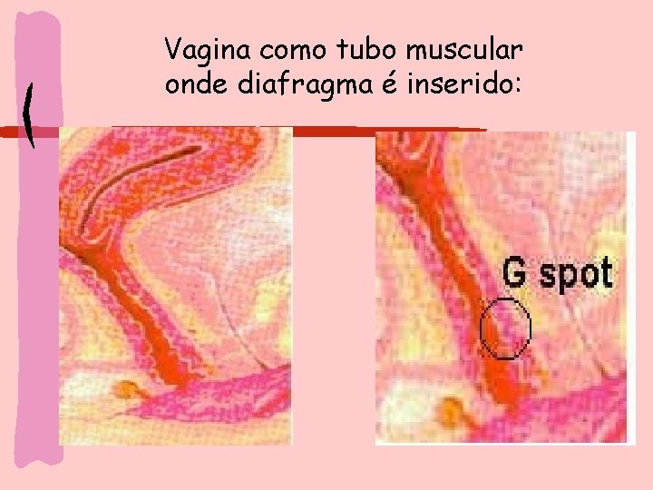 Vagina como tubo muscular onde diafragma é inserido: 