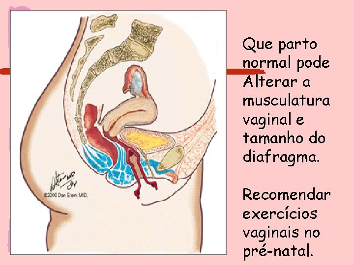 Que parto normal pode Alterar a musculatura vaginal e tamanho do diafragma. Recomendar exercícios