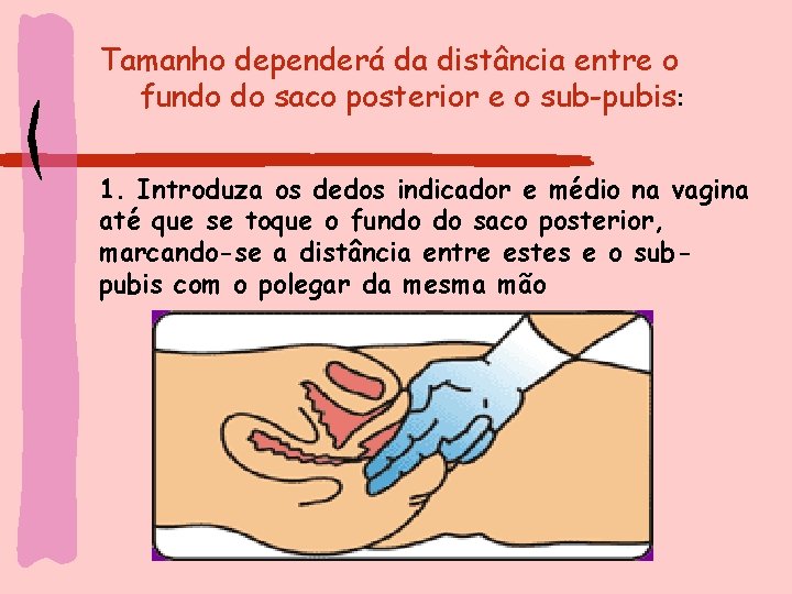 Tamanho dependerá da distância entre o fundo do saco posterior e o sub-pubis: 1.