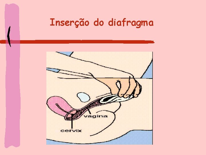 Inserção do diafragma 
