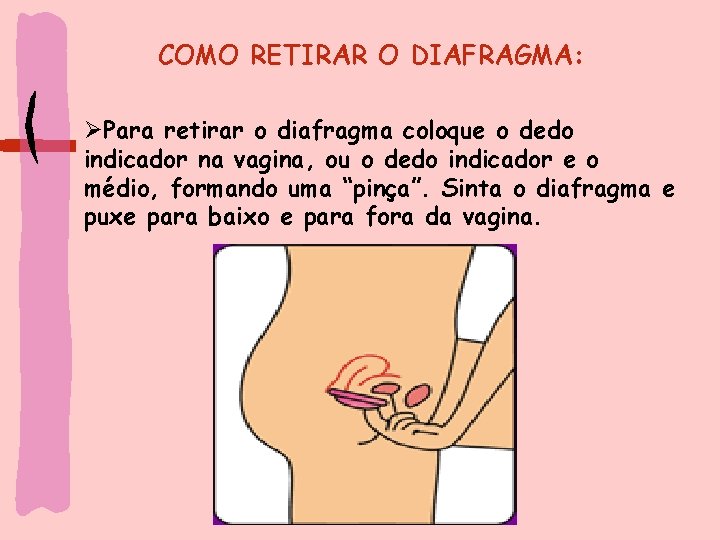 COMO RETIRAR O DIAFRAGMA: ØPara retirar o diafragma coloque o dedo indicador na vagina,