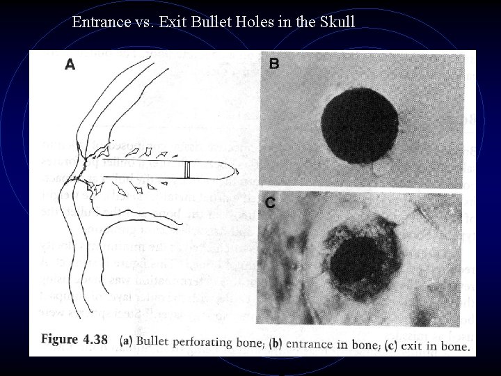 Entrance vs. Exit Bullet Holes in the Skull 