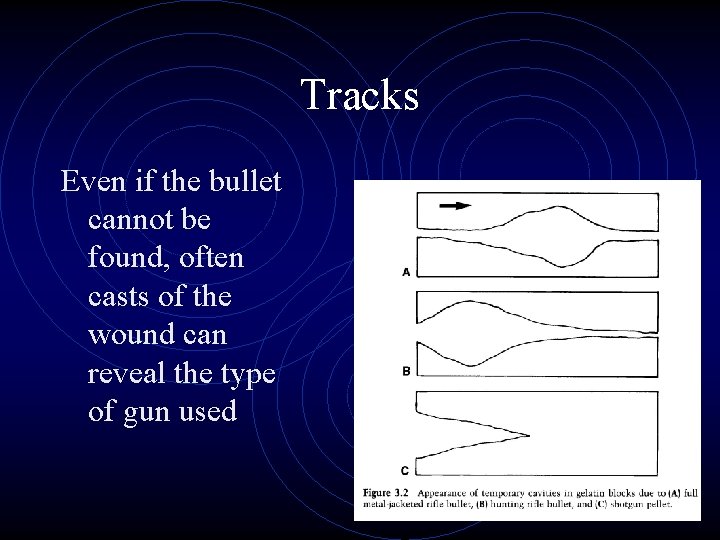 Tracks Even if the bullet cannot be found, often casts of the wound can