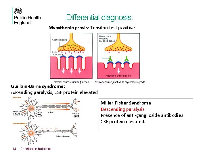 Differential diagnosis: Myasthenia gravis: Tensilon test positive Guillain-Barre syndrome: Ascending paralysis, CSF protein elevated