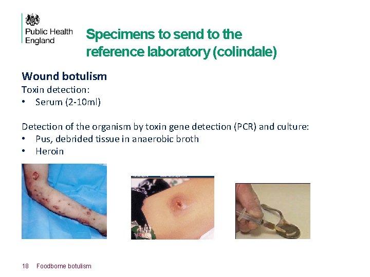 Specimens to send to the reference laboratory (colindale) Wound botulism Toxin detection: • Serum