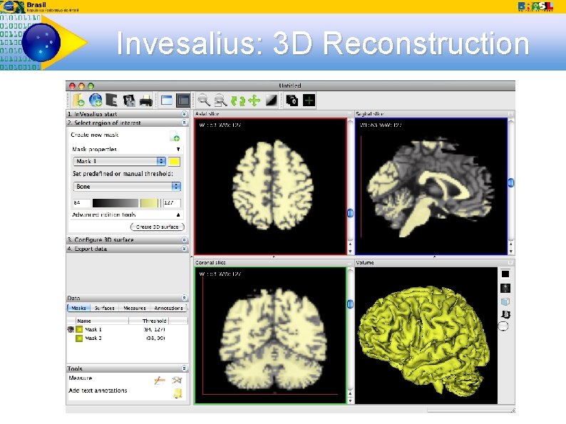 Invesalius: 3 D Reconstruction 