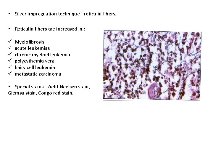 § Silver impregnation technique - reticulin fibers. § Reticulin fibers are increased in :