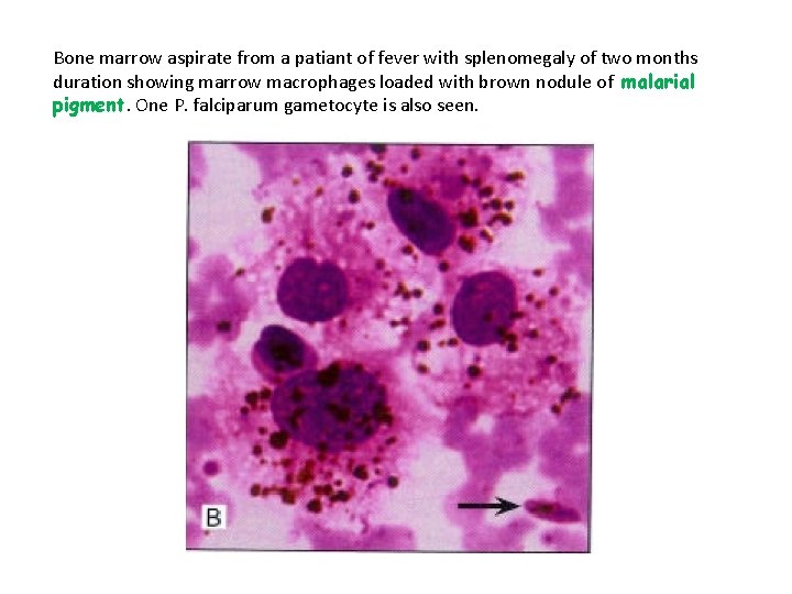 Bone marrow aspirate from a patiant of fever with splenomegaly of two months duration