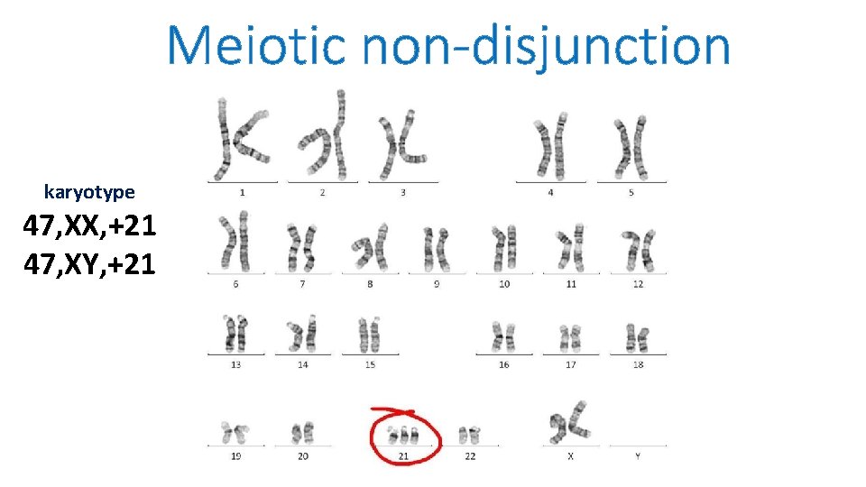 Meiotic non disjunction karyotype 47, XX, +21 47, XY, +21 
